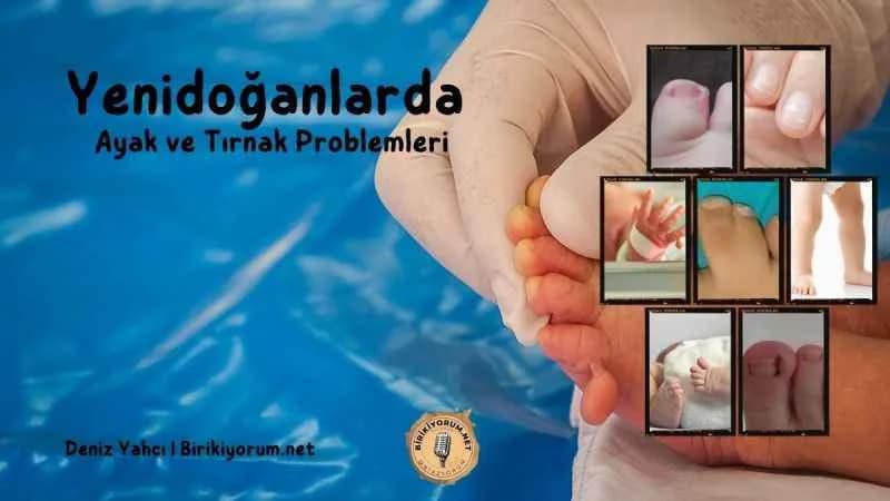 Yenidoğanlarda Ayak ve Tırnak Problemleri